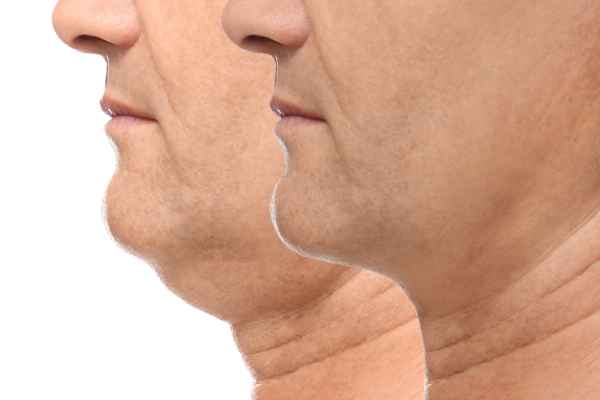 HIFU - Breakthrough in Anti - ageing 2 hifu results Sudbury
