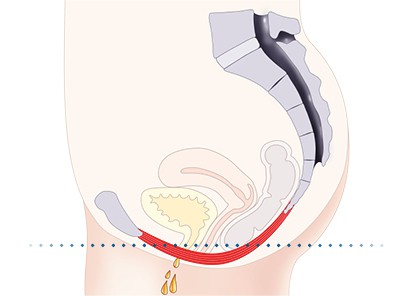Pelvic-Floor Muscle Repair 5 Pelvic floor muscles Sudbury