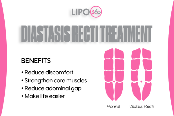 Revolutionising Muscle Repair: The Power of LIPO360 Body Sculpt Post-Injury 5 diastasis recti treatment Sudbury
