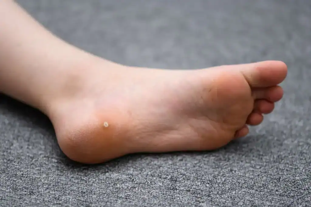 Cryotherapy For Warts And Also Verrucas 2 Image of verruca on the bottom of the foot that able to be treated with Cryotherapy Sudbury