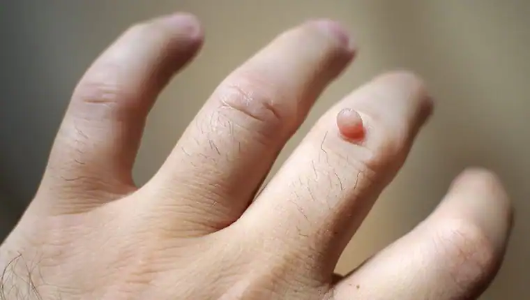 Cryotherapy For Warts And Also Verrucas 1 Image of blemish that Cryotherapy Sudbury can remove with Lipo 360.