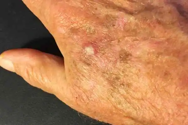 Cryopen For Actinic Keratoses 1 Image of Actinic keratoses Sudbury on a person hand