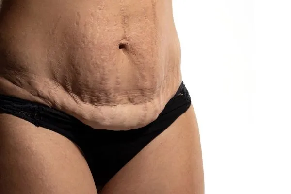 The Science of Skin Tightening 1 The science behind skin tightening Sudbury picture of a woman's sagging skin on the stomach